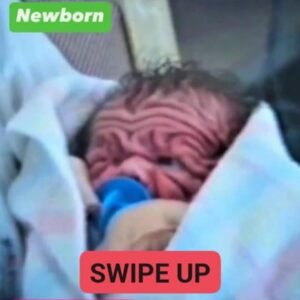 In 1993, This Boy Was Born With Enough Skin For A Five-Year-Old. But Wait Till You See Him Today